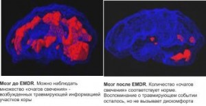 мозг до и после EMDR